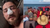 Agredido em Porto de Galinhas passa por cirurgia em MT após identificar 4 fraturas no rosto